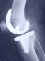 Knieprothese (zijaanzicht)