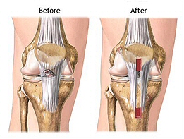 Walking with torn knee ligament torn knee ligament ache