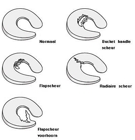 Kijkoperatie, knie, meniscus